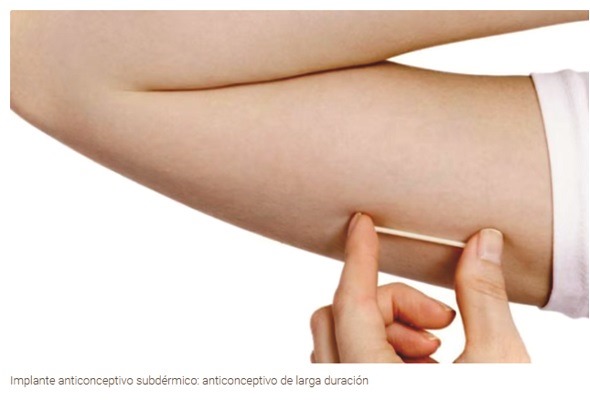 anticonceptivo subdérmico